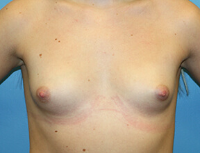 Breast Implants Before